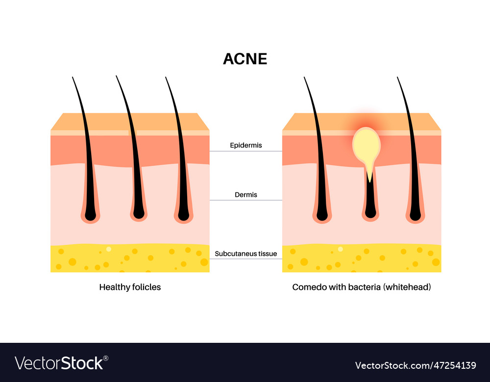 Acne treatment poster Royalty Free Vector Image