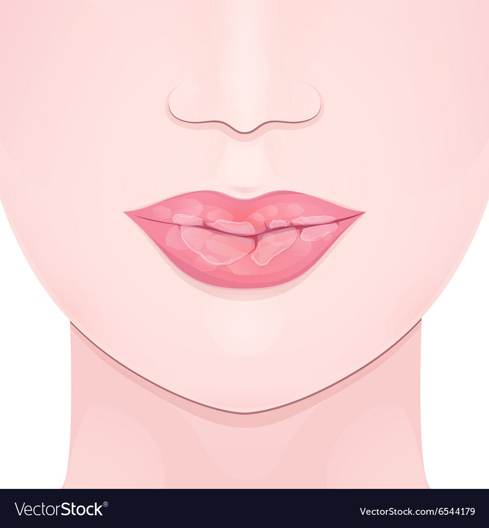 Dry Lips Vector Art, Icons, and Graphics for Free Download