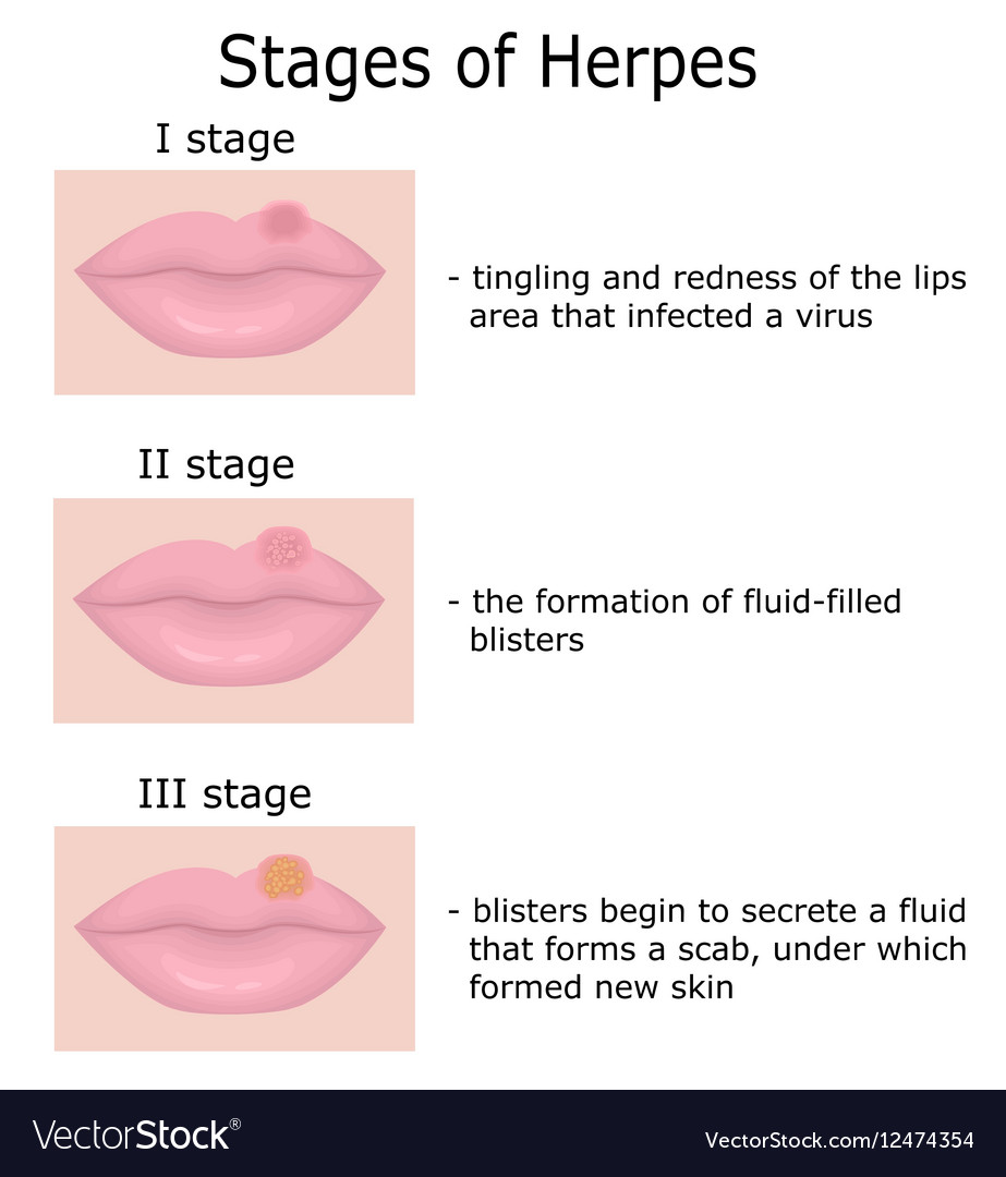 Stages of Herpes Royalty Free Vector Image - VectorStock