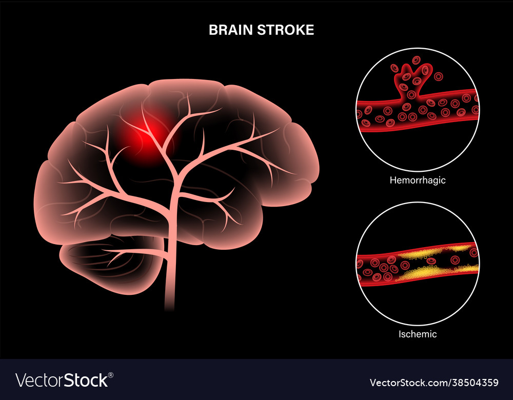 Brain stroke ishemic and hemorrhagic Royalty Free Vector