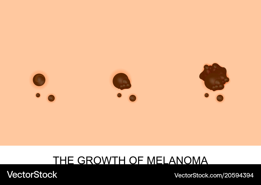 Growth of melanoma Royalty Free Vector Image VectorStock