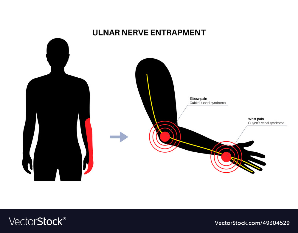 Ulnar nerve entrapment