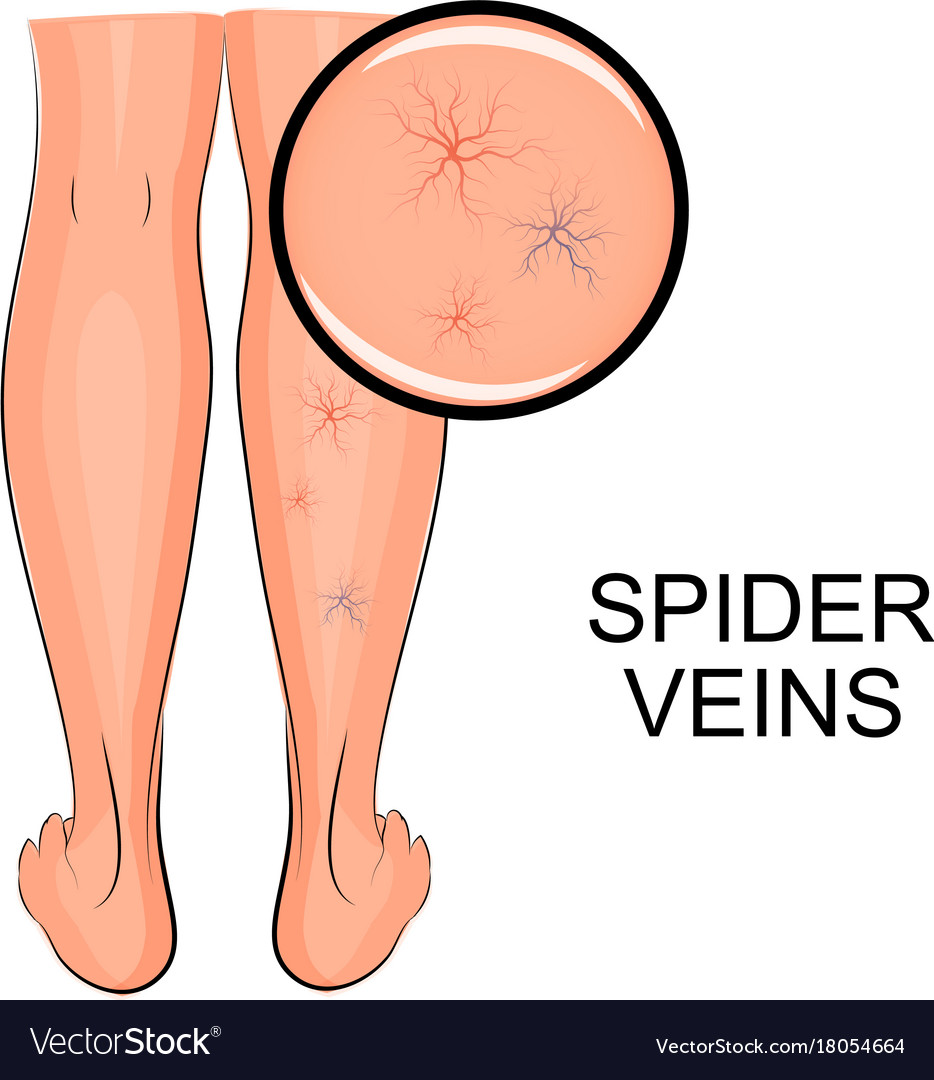 Варикоз на ногах рисунок