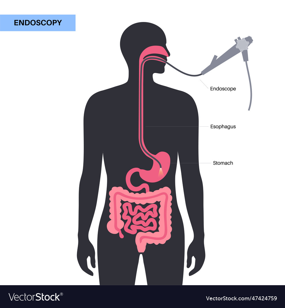 Gastroscopy Endoscopy Procedure Royalty Free Vector Image