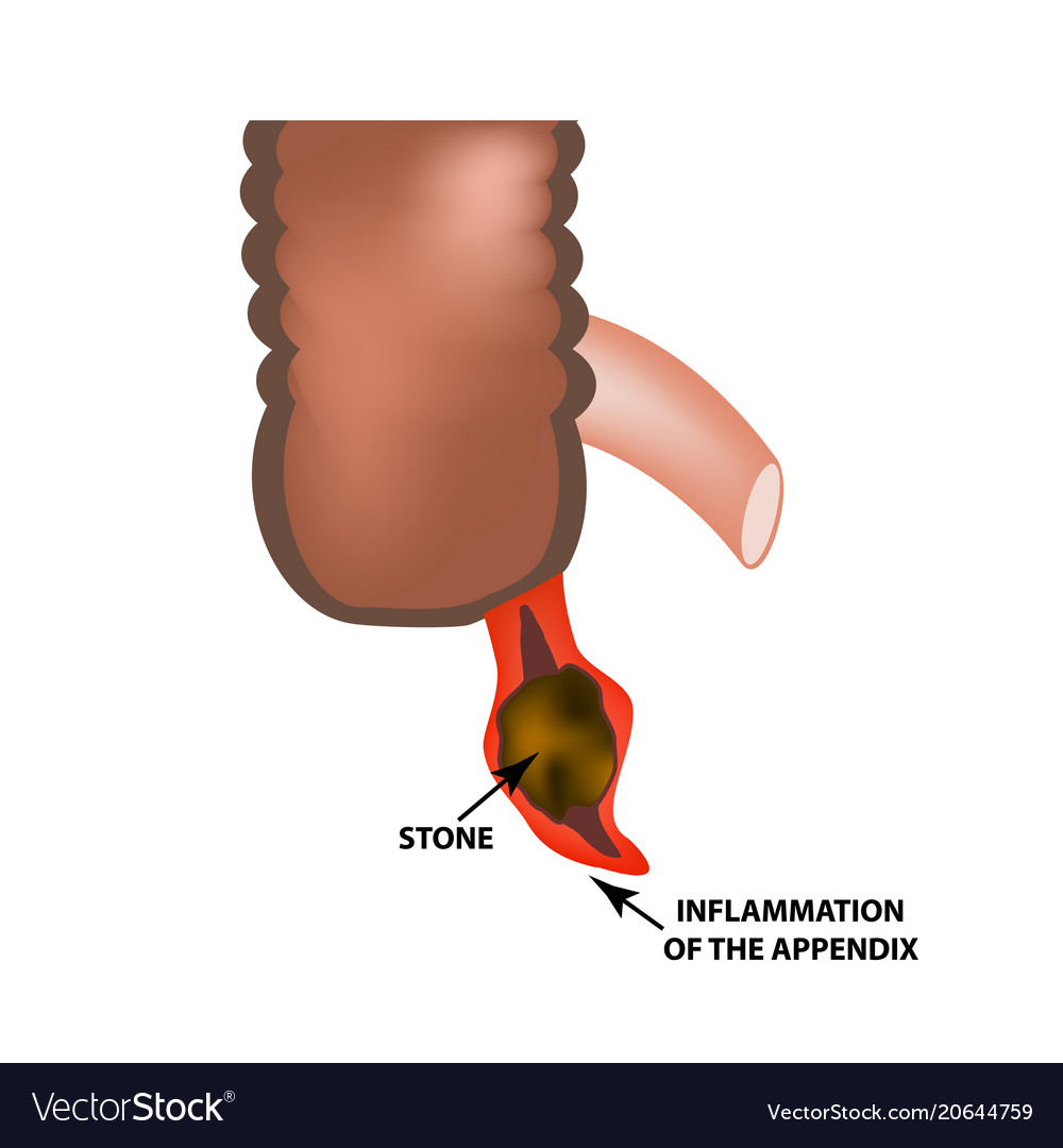 Inflammation of the appendix appendicitis Vector Image