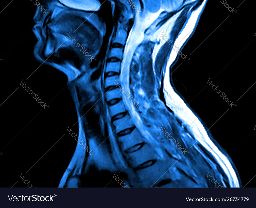 Magnetic Resonance Imaging Of The Spine Showing Multiple Intramedullary