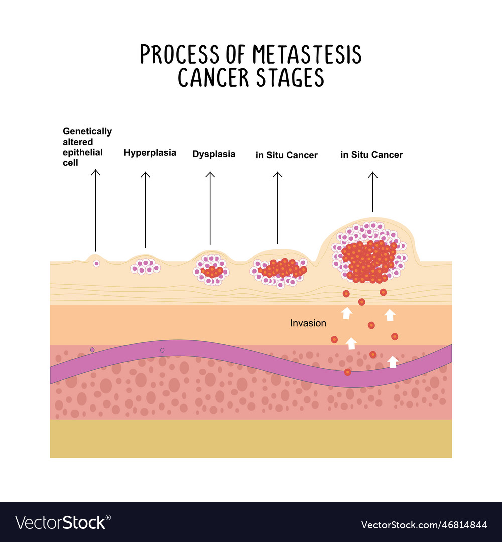 Process of metastases cancer stages isolated on Vector Image