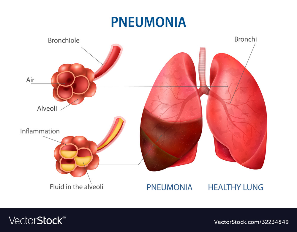 Pneumonia Realistic Set Royalty Free Vector Image