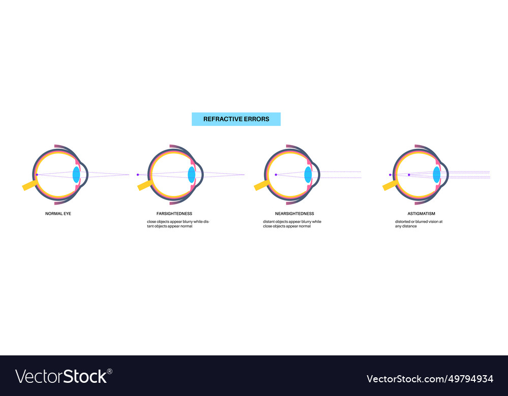 Refractive errors poster Royalty Free Vector Image