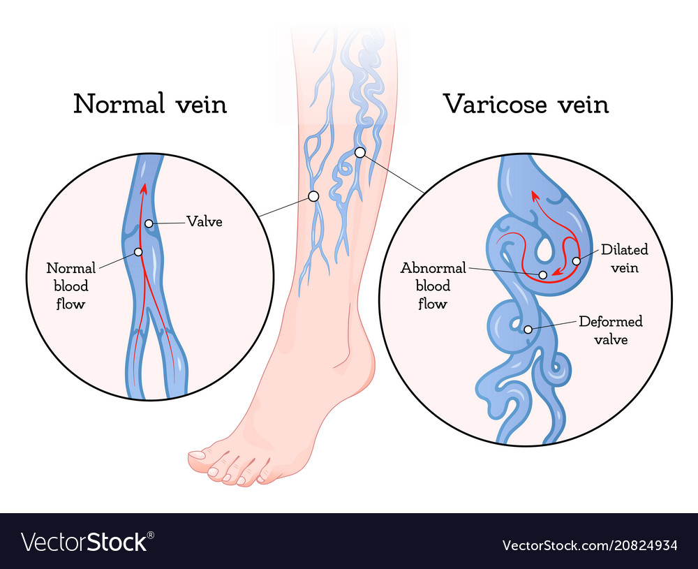 Varicose veins poster Royalty Free Vector Image