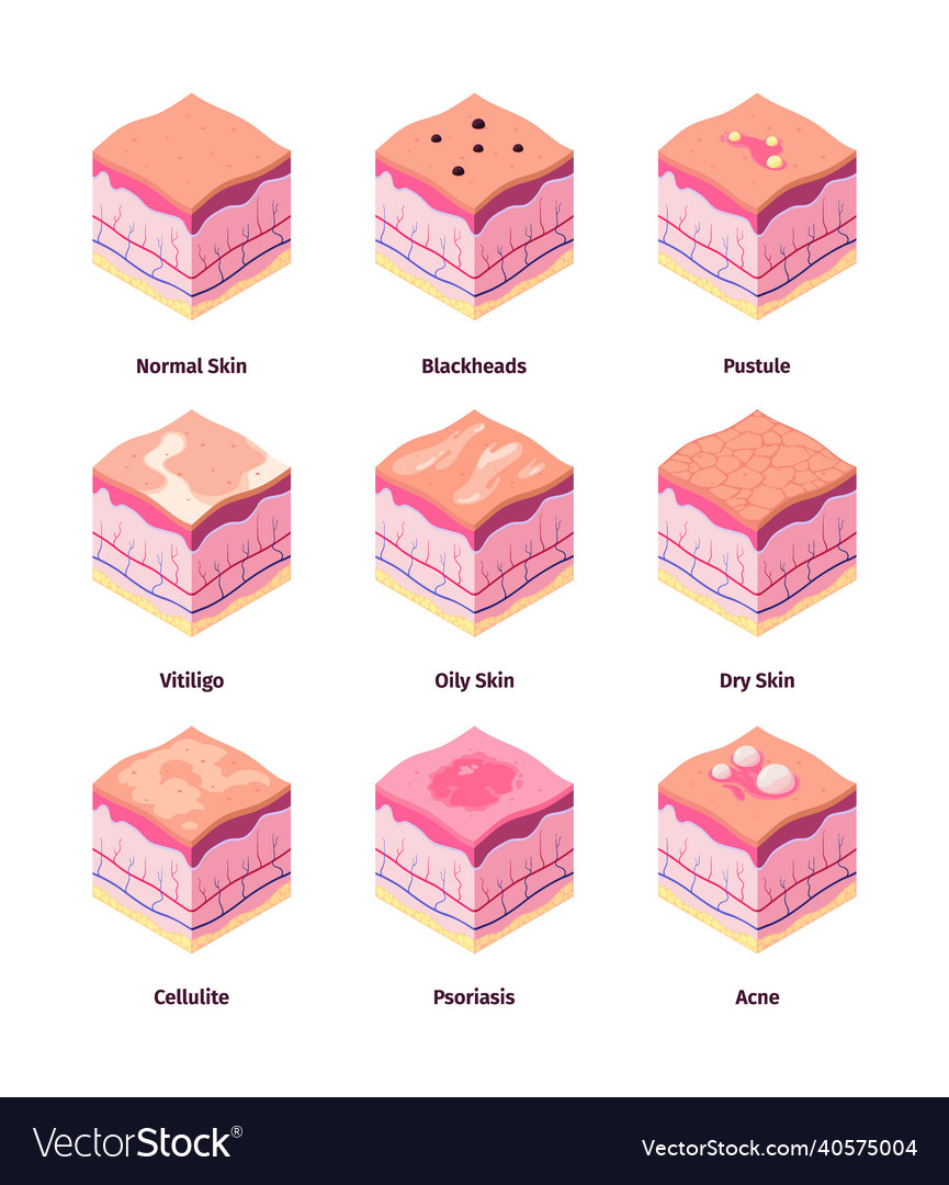 Type of skin dermis structure human body cross Vector Image