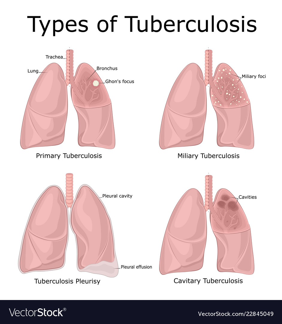 Types tuberculosis Royalty Free Vector Image - VectorStock