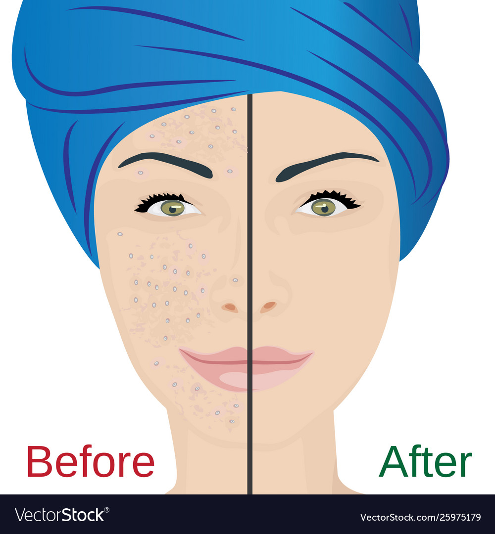 Acne pustules on a woman face Royalty Free Vector Image