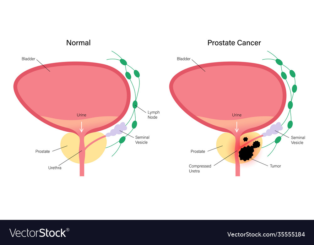 Prostate cancer concept Royalty Free Vector Image