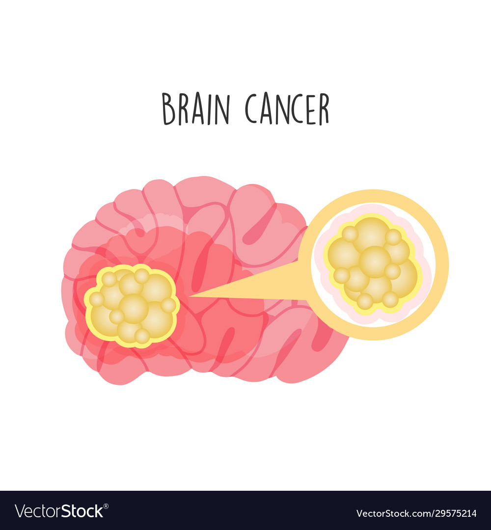 Brain cancer Royalty Free Vector Image - VectorStock