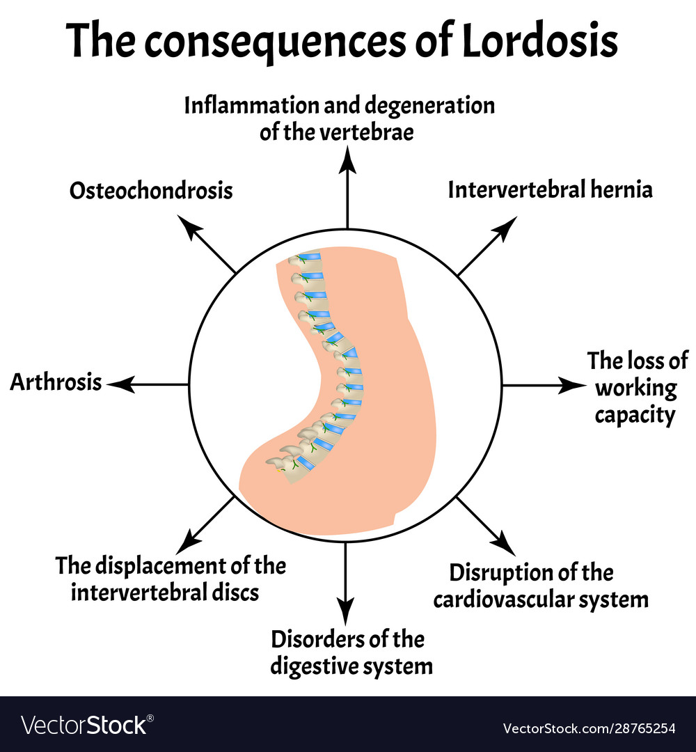 The consequence of which are. Spine curves kyphosis and lordosis. lordosis treatment. consequences of improper nutrition.