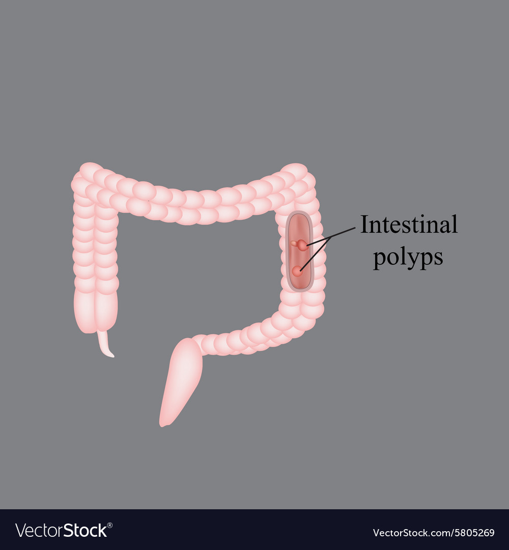 Polyp in the intestine colon