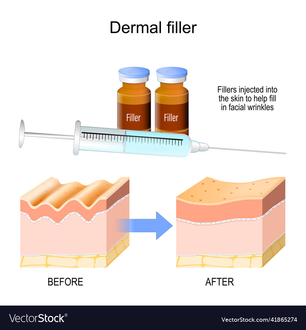 Dermal filler fillers injected into the skin Vector Image