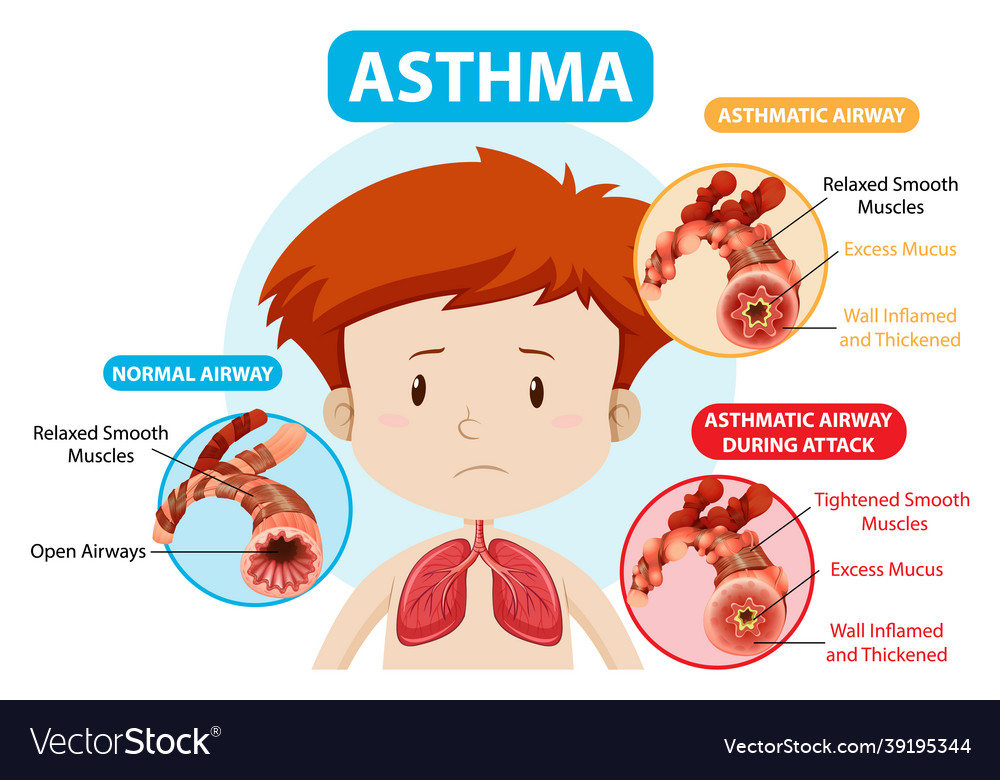 Asthma diagram with normal airway and asthmatic Vector Image