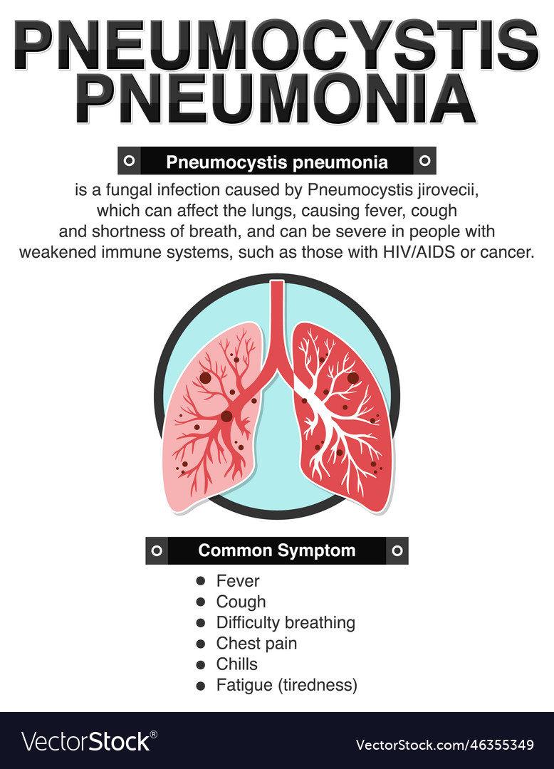 Informative poster of pneumocystis pneumonia Vector Image