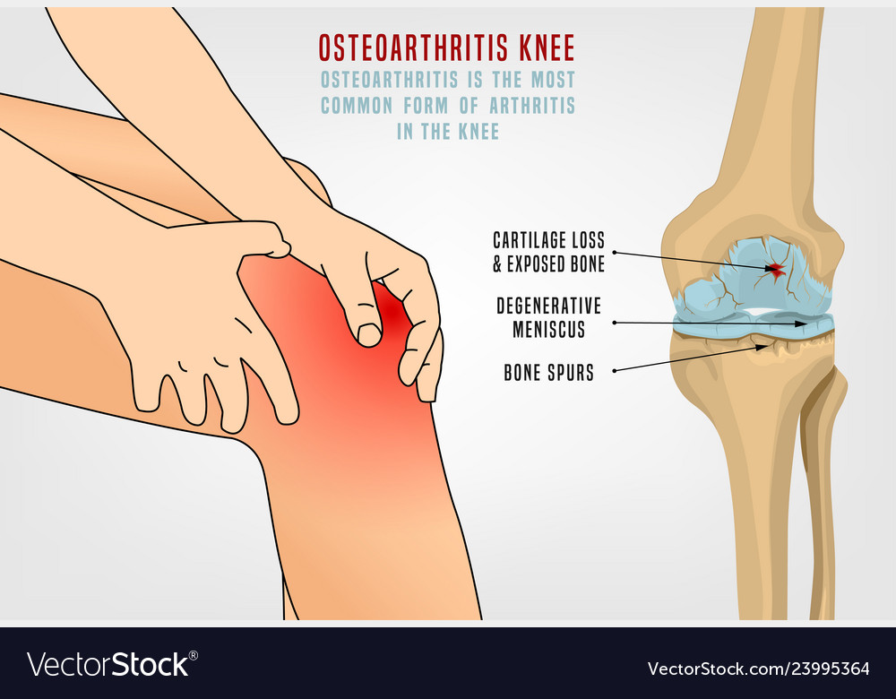 Knee Osteoarthritis Poster