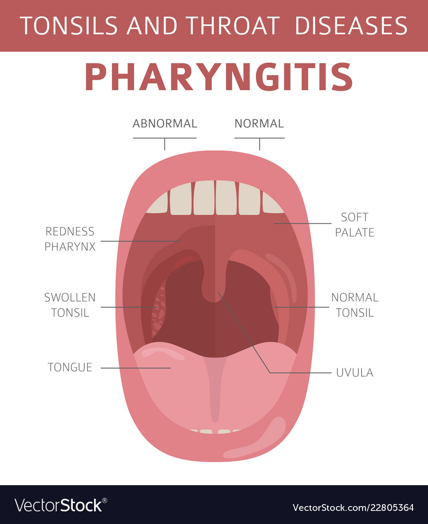 Tonsils and throat diseases pharyngitis symptoms Vector Image