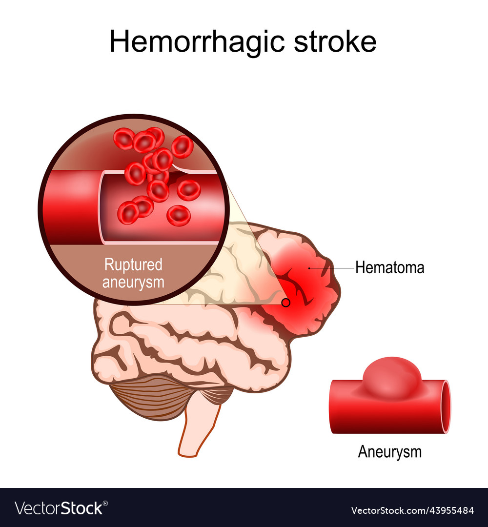 Hemorrhagic Stroke Human Brain With Hematoma Vector Image 5793