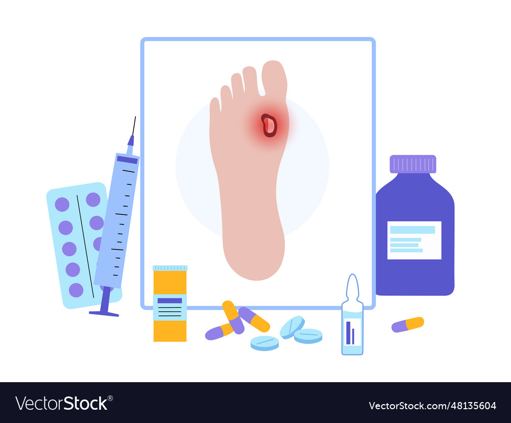 Diabetic foot ulcers Royalty Free Vector Image