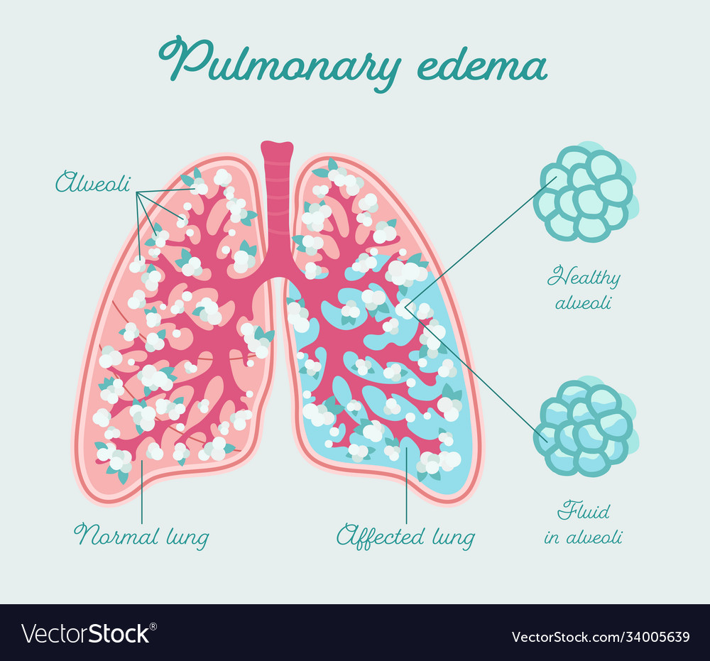 Pulmonary Edema Alveoli