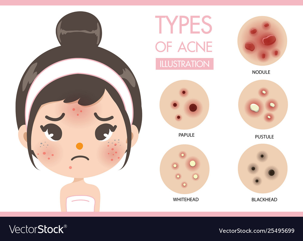 Acne worry girl Royalty Free Vector Image - VectorStock