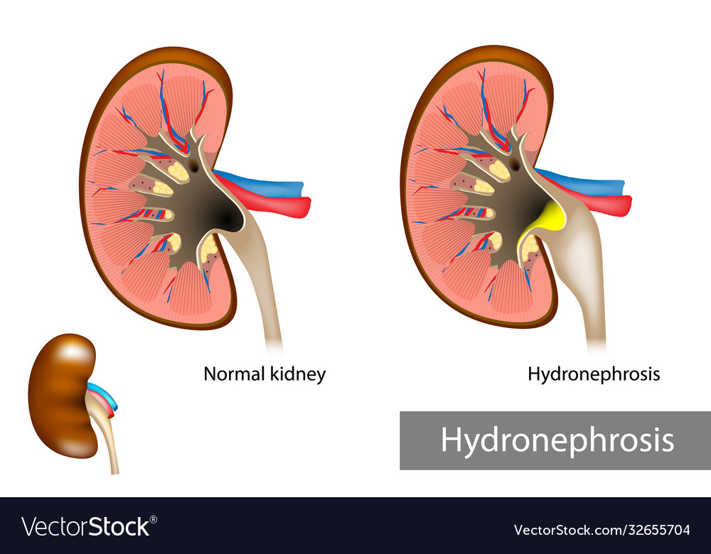 Hydronephrosis urinary tract dilation Royalty Free Vector