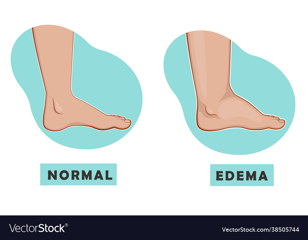 A swollen foot and ankle and normal foot vector image A swollen foot and ankle and normal foot