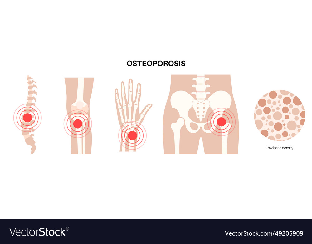 Osteoporosis medical poster Royalty Free Vector Image