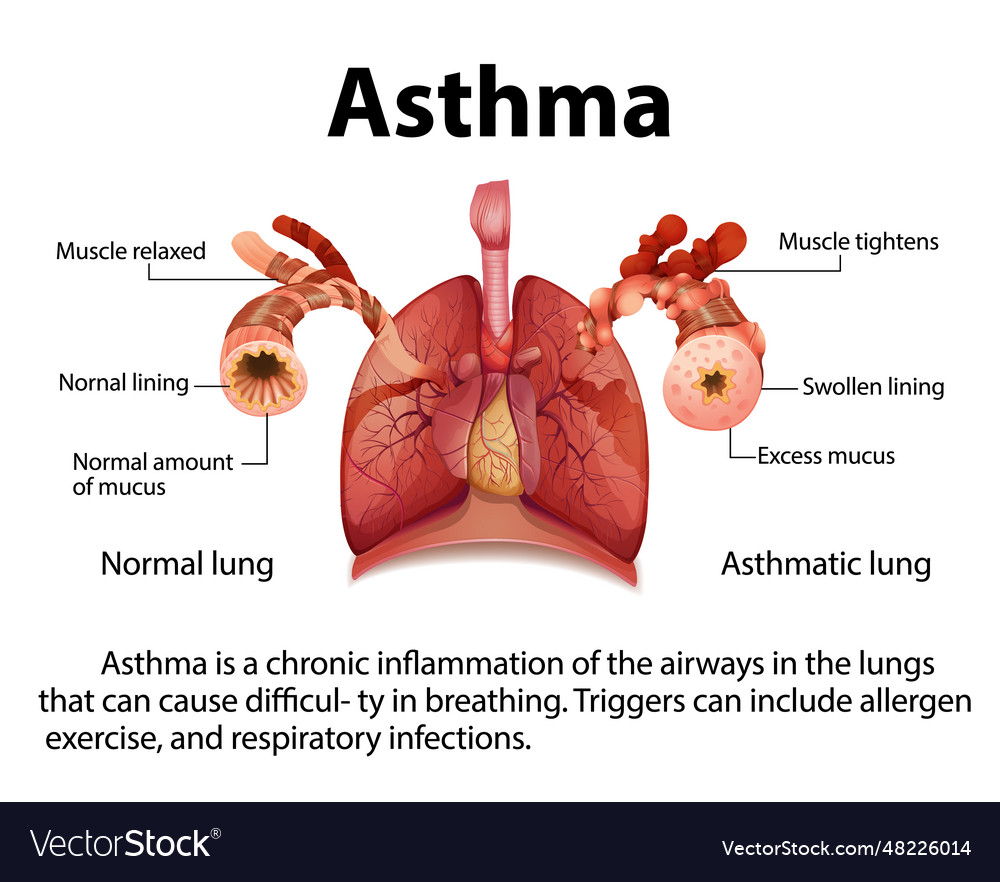 Comparing normal and asthma lungs in medical Vector Image