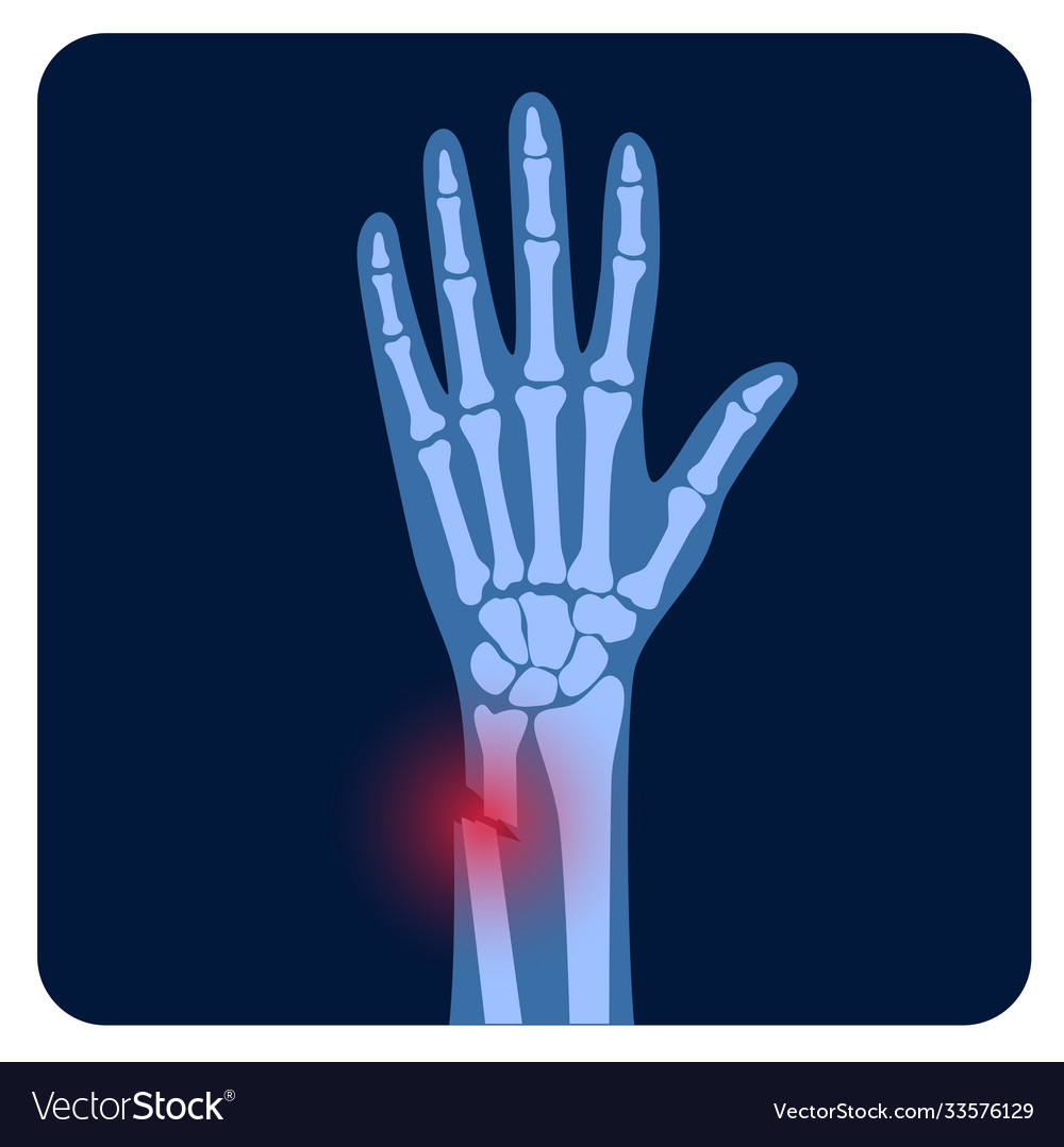 Fracture x ray concept