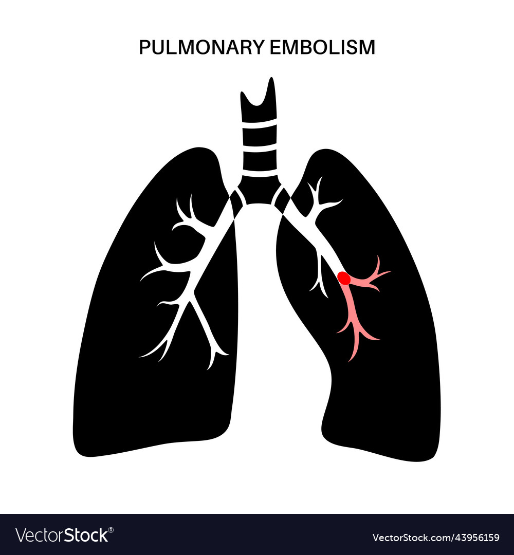 Pulmonary Embolism Disease Royalty Free Vector Image | The Best Porn ...