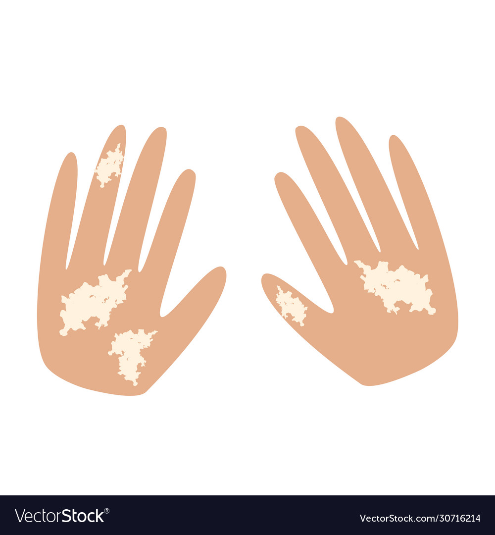 Vitiligo on hands white spots skin