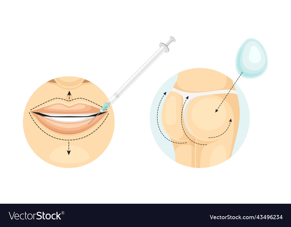 Plastic surgery for lips and buttocks with stipple