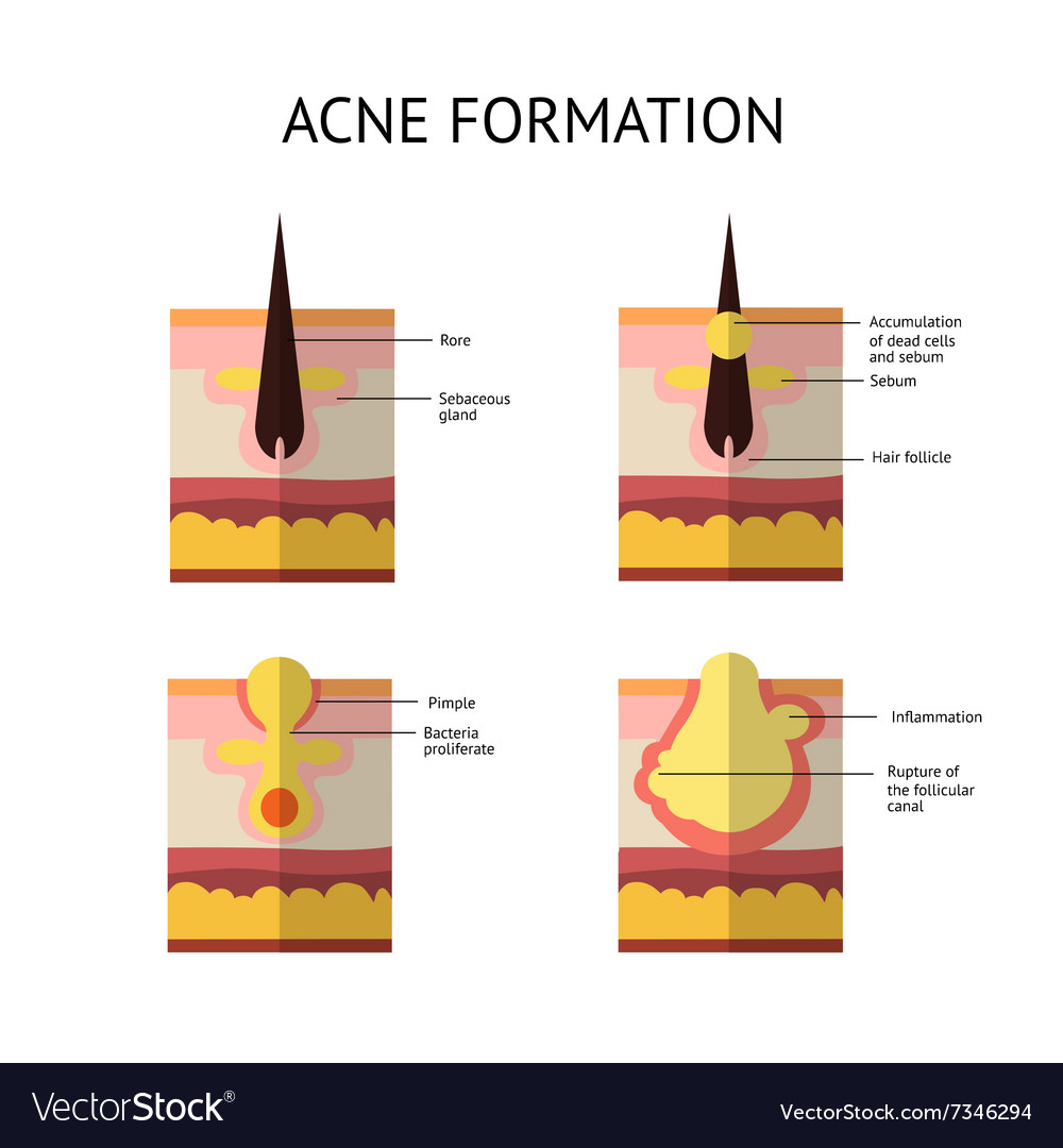 Formation of skin acne or pimple The sebum in the Vector Image