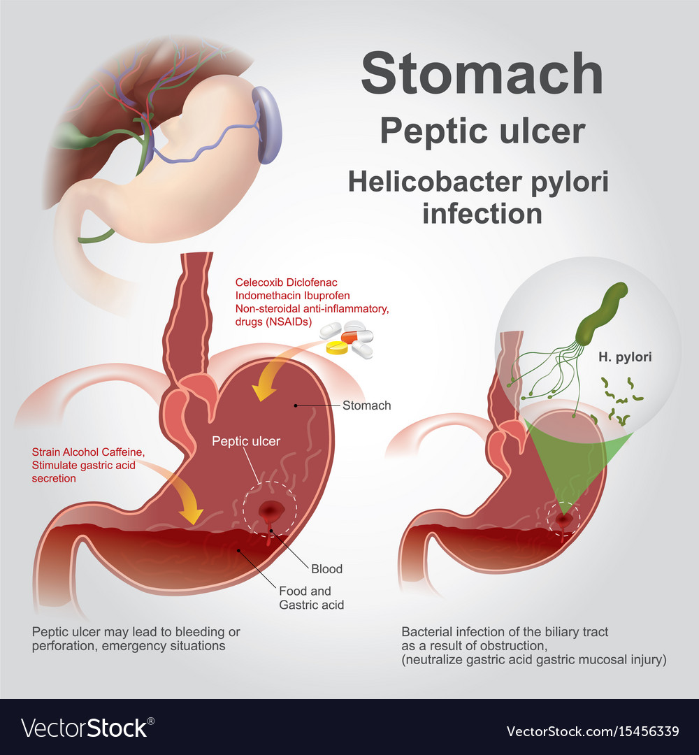 Stomach Peptic Ulcer Charts Royalty Free Vector Image