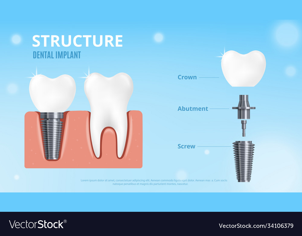 Dental implant structure - realistic poster mockup