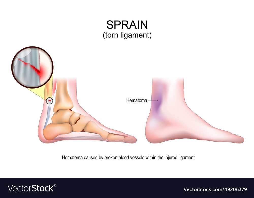 Sprain torn ligament sports trauma