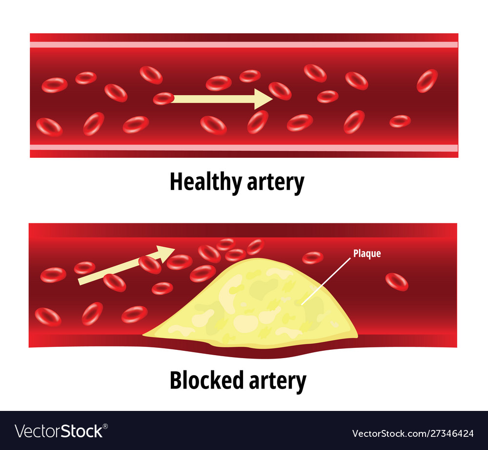 Blocked artery fat stuck in blood Royalty Free Vector Image