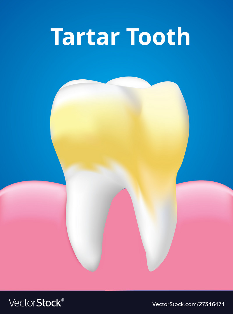 Tartar tooth with gum dental care concept