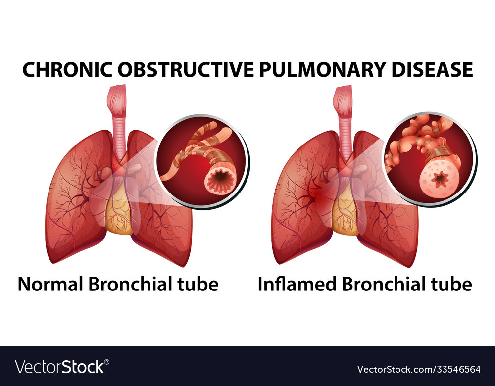 Chronic obstructive pulmonary disease Royalty Free Vector