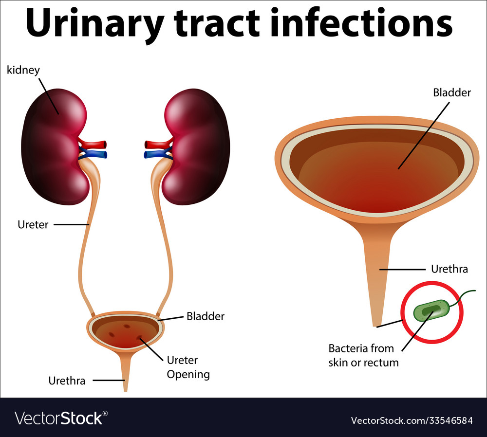 Informative urinary tract infections Royalty Free Vector