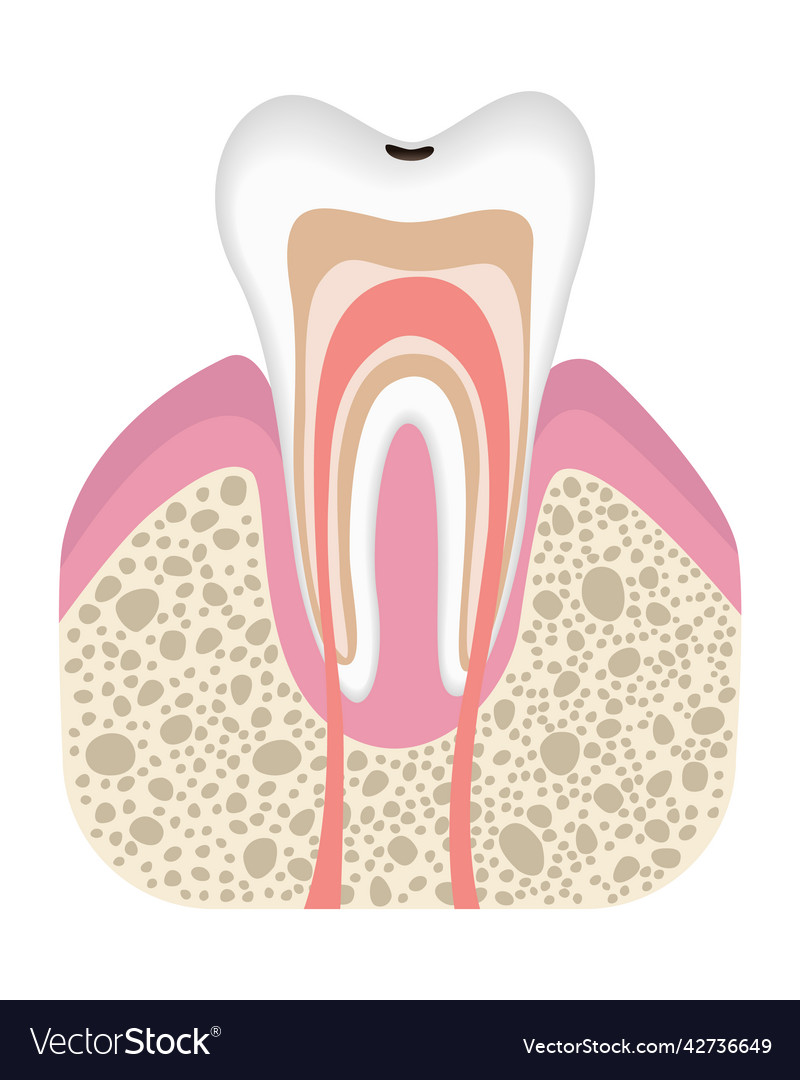 Stage of caries development tooth structure vector image Stage of caries development tooth structure
