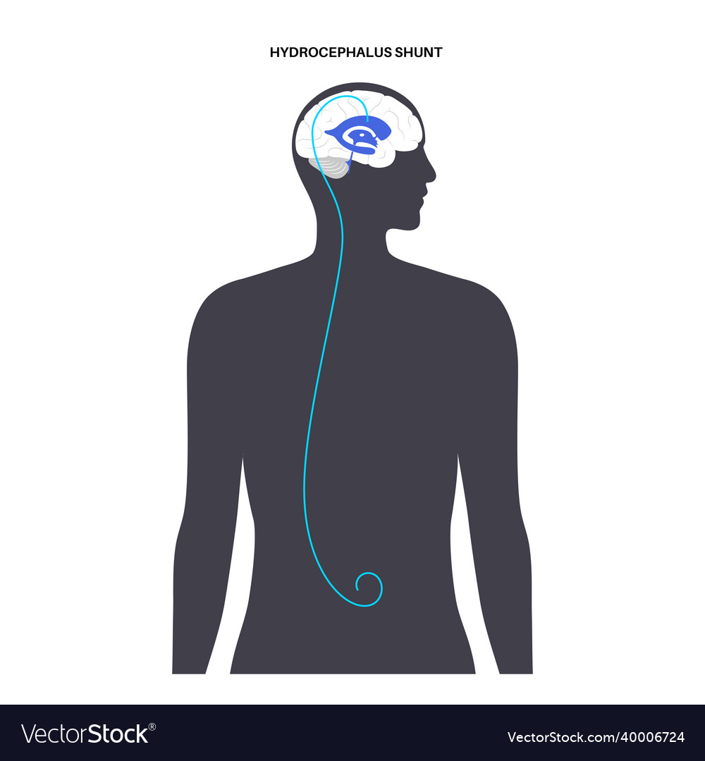 Hydrocephalus Shunt Anatomy