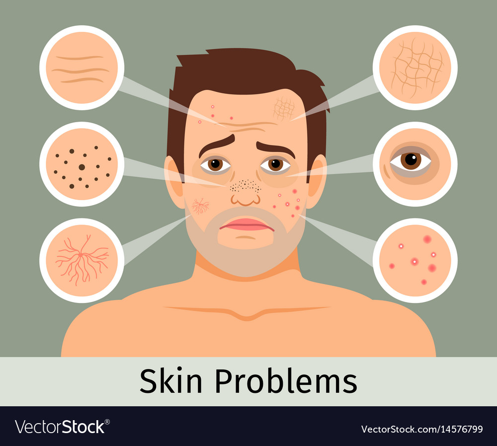 male-facial-skin-problems-royalty-free-vector-image