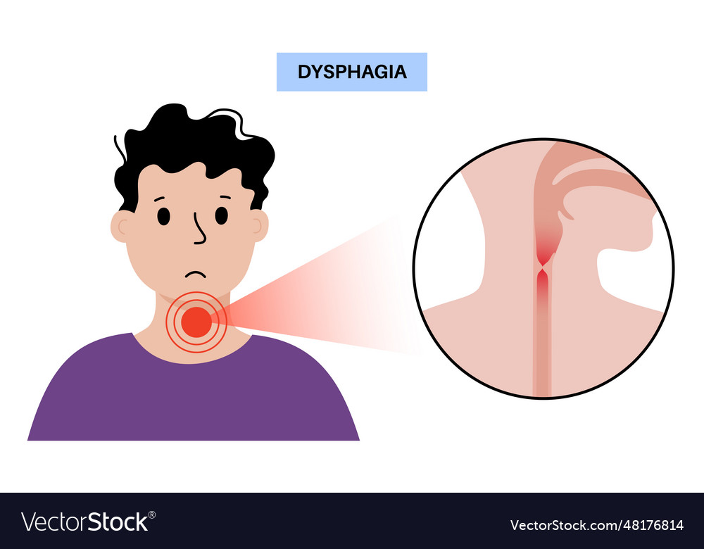 Dysphagia medical poster Royalty Free Vector Image